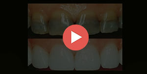 smile makeover tallahassee dentist
