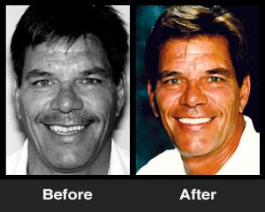 Crooked Teeth before and After