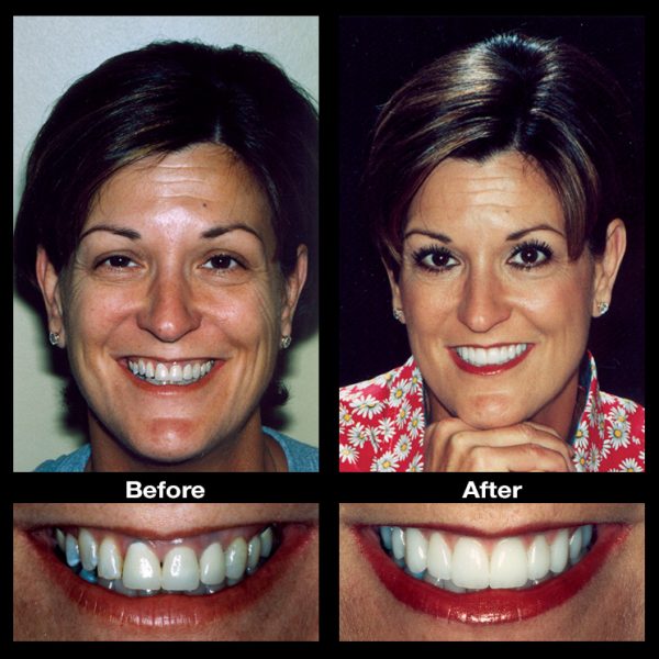 teeth repair