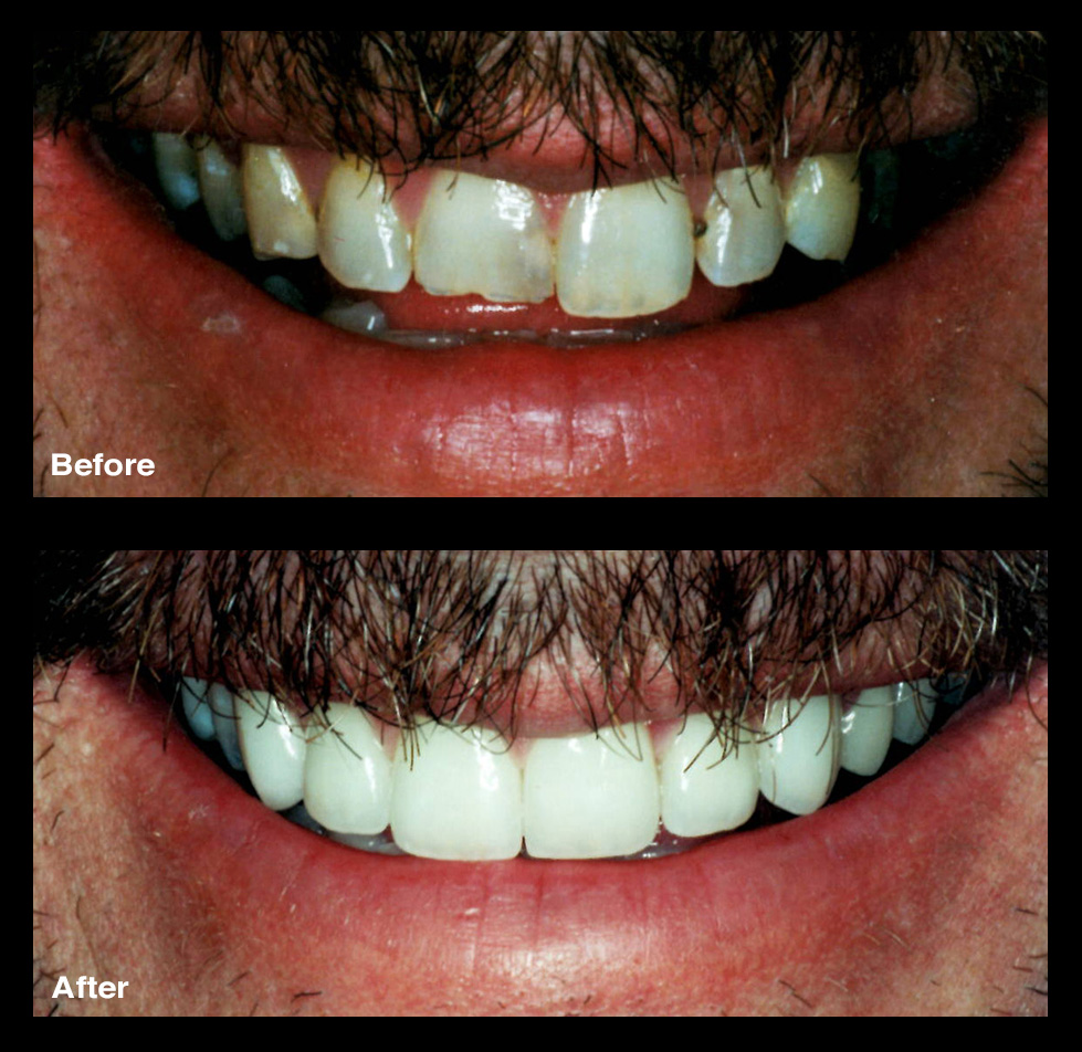 rotten teeth before and after