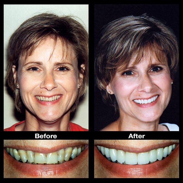 stained teeth treatment