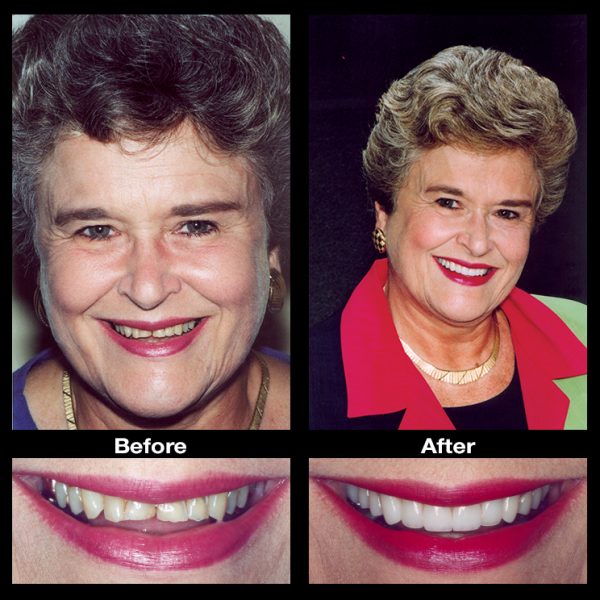 worn teeth restoration old age